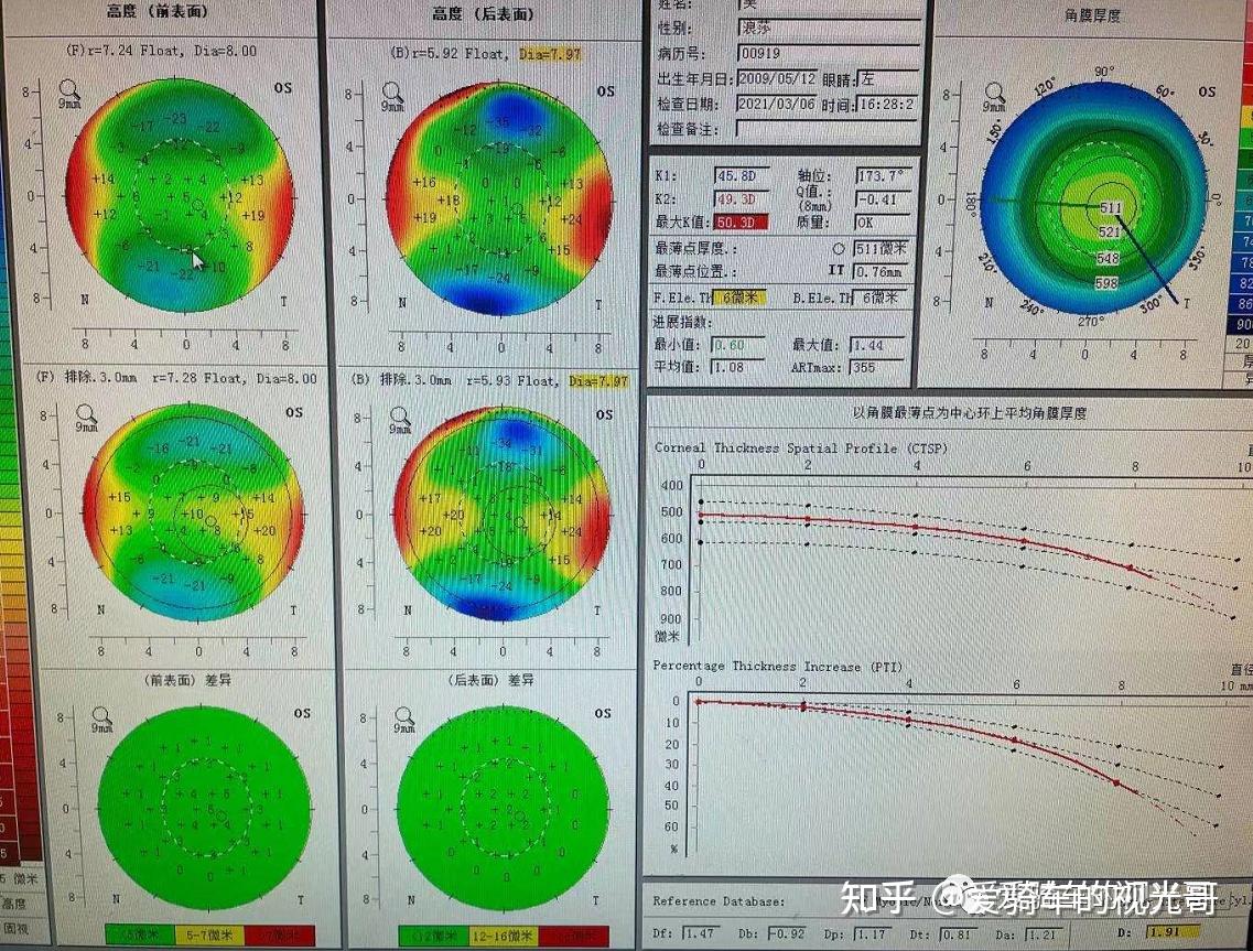 20 前表面高度 4后表面高度 5 角膜最薄点507umod k1 46.00 k2 48.