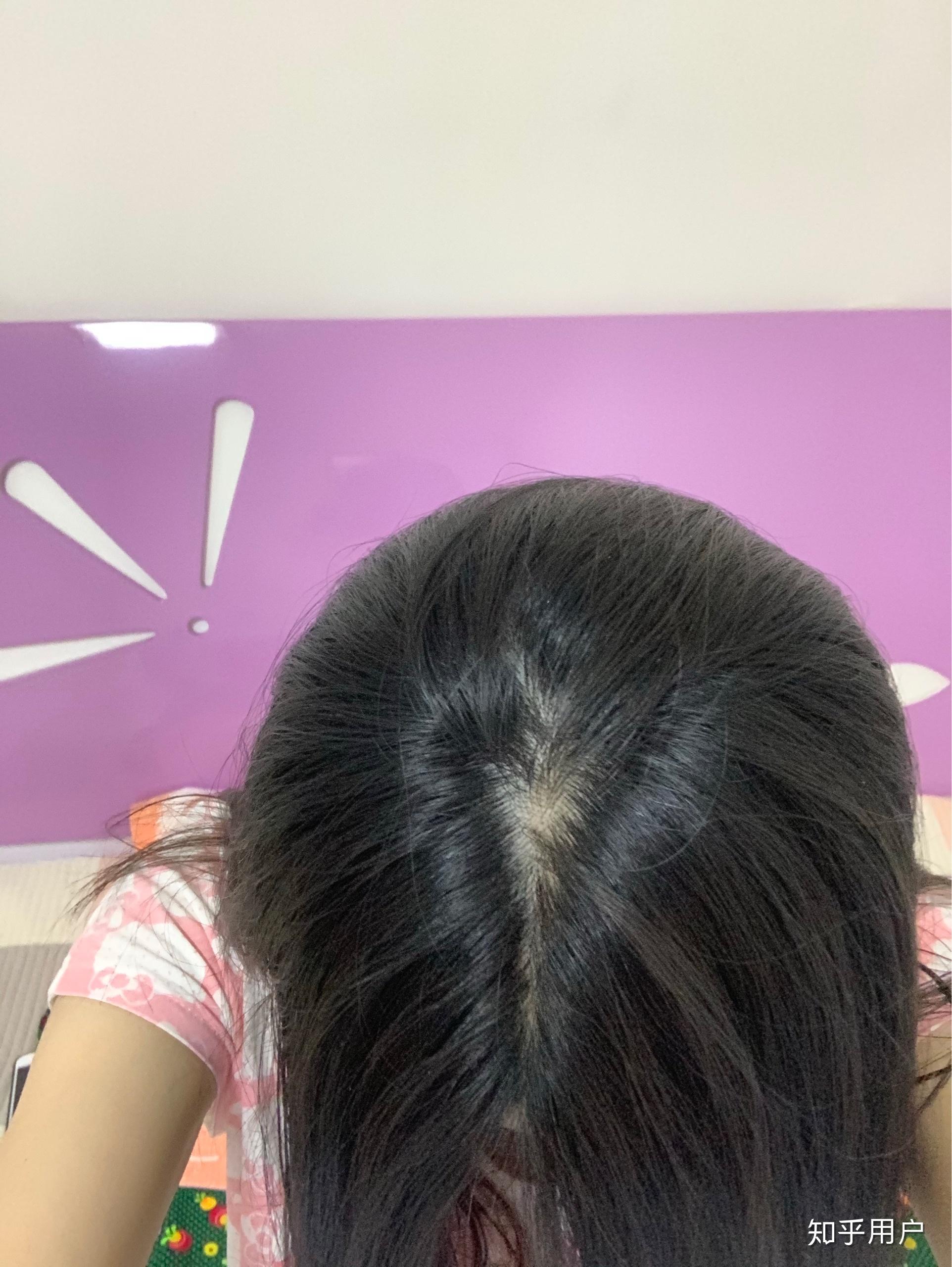 女生头顶头发少是什么体验