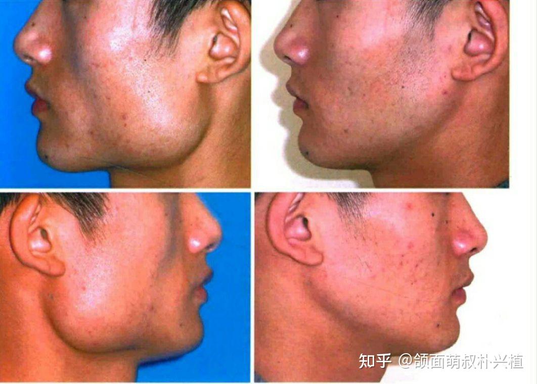 这是下颌骨肥大吗? - 知乎