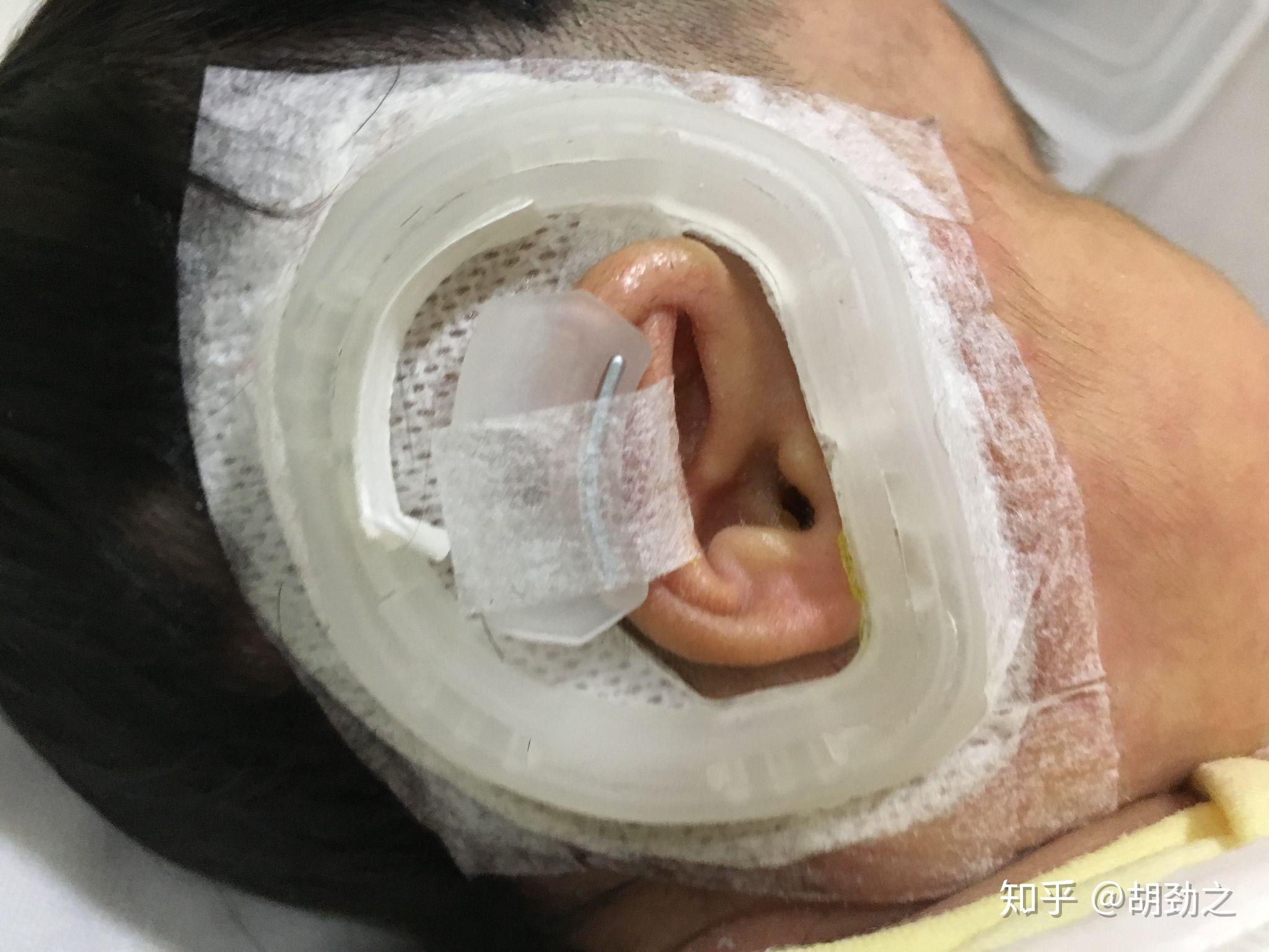 图一,上侧图片,右侧隐耳矫正前