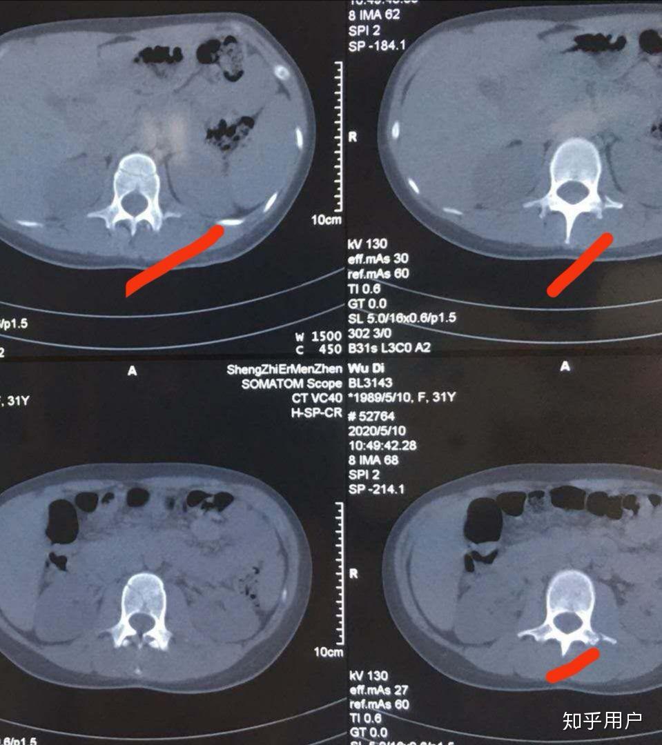 骨折是怎么样的感受经历怎样的恢复