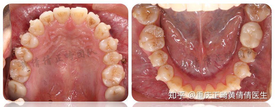 前突伴下颌第二磨牙缺失的隐形矫治病例