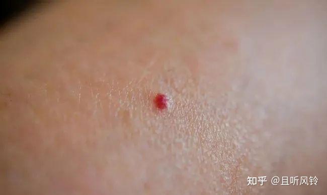 几种常见皮肤问题 - 知乎
