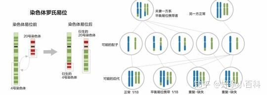 染色体罗氏易位 - 知乎