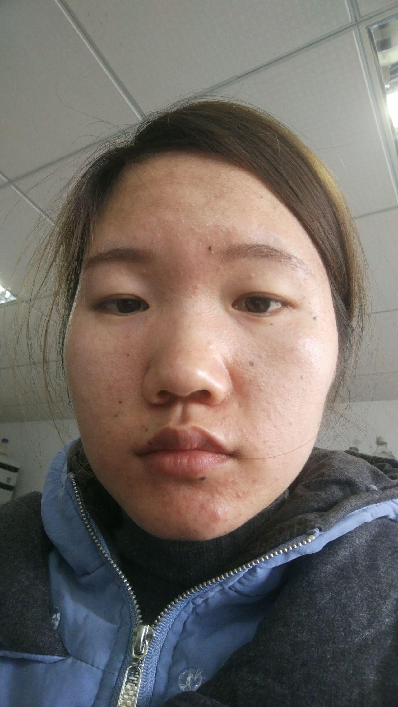 怎么样除去痘痘脸？