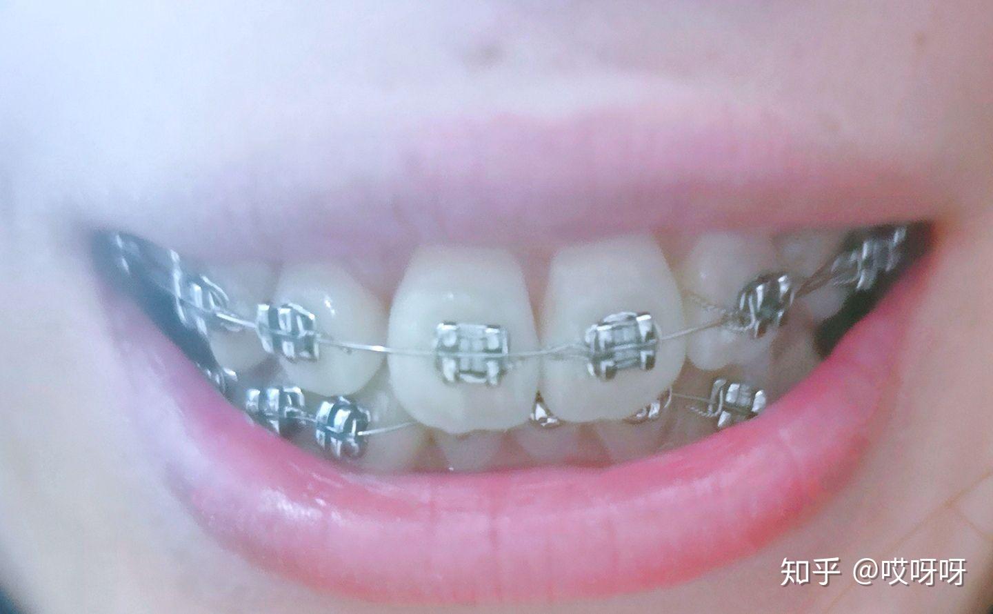 正畸分享虎牙埋伏牙