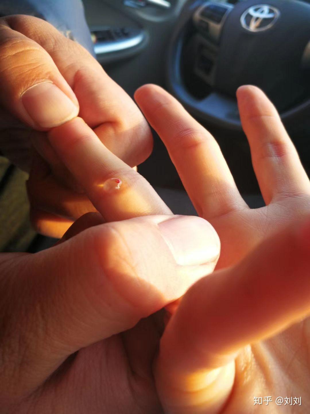 攻心翻到底是一种什么病? - 知乎