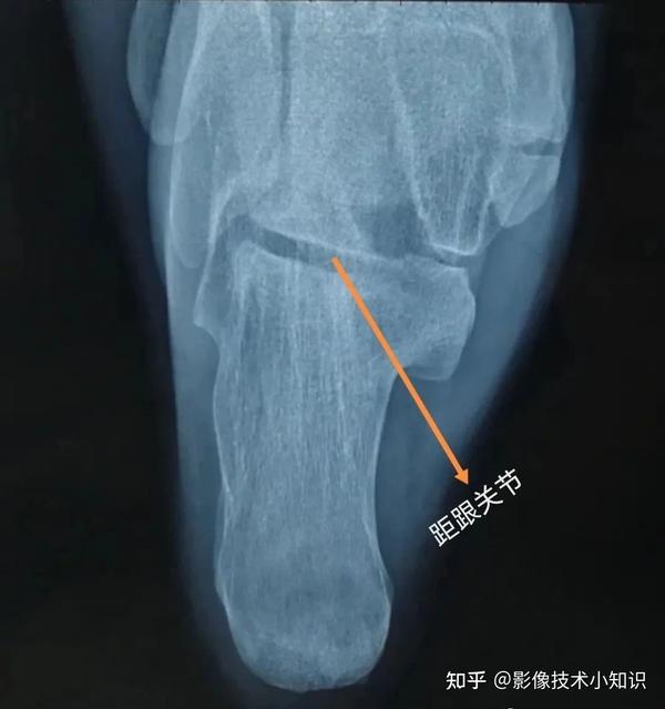 如何拍出标准的跟骨轴位片 - 知乎