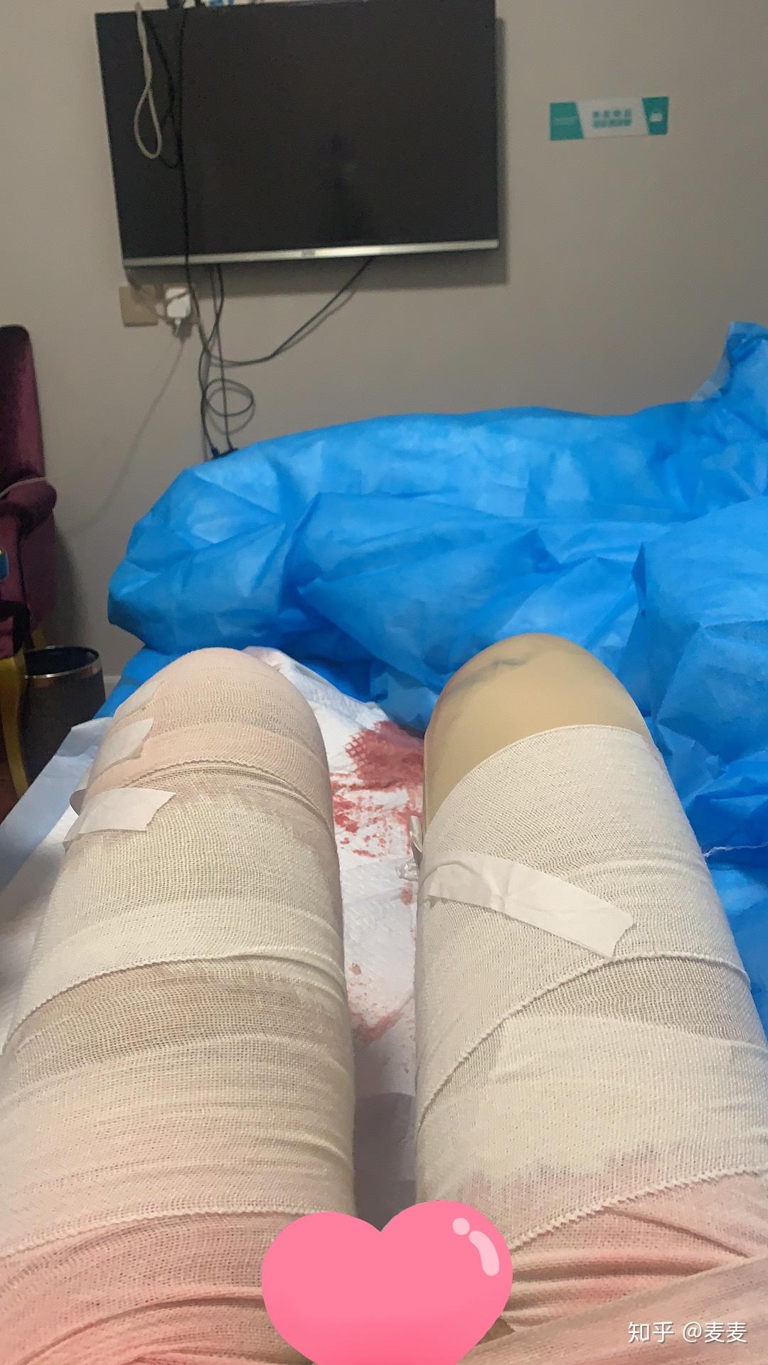 大腿吸脂二三事(供有吸脂意向的妹子参考)