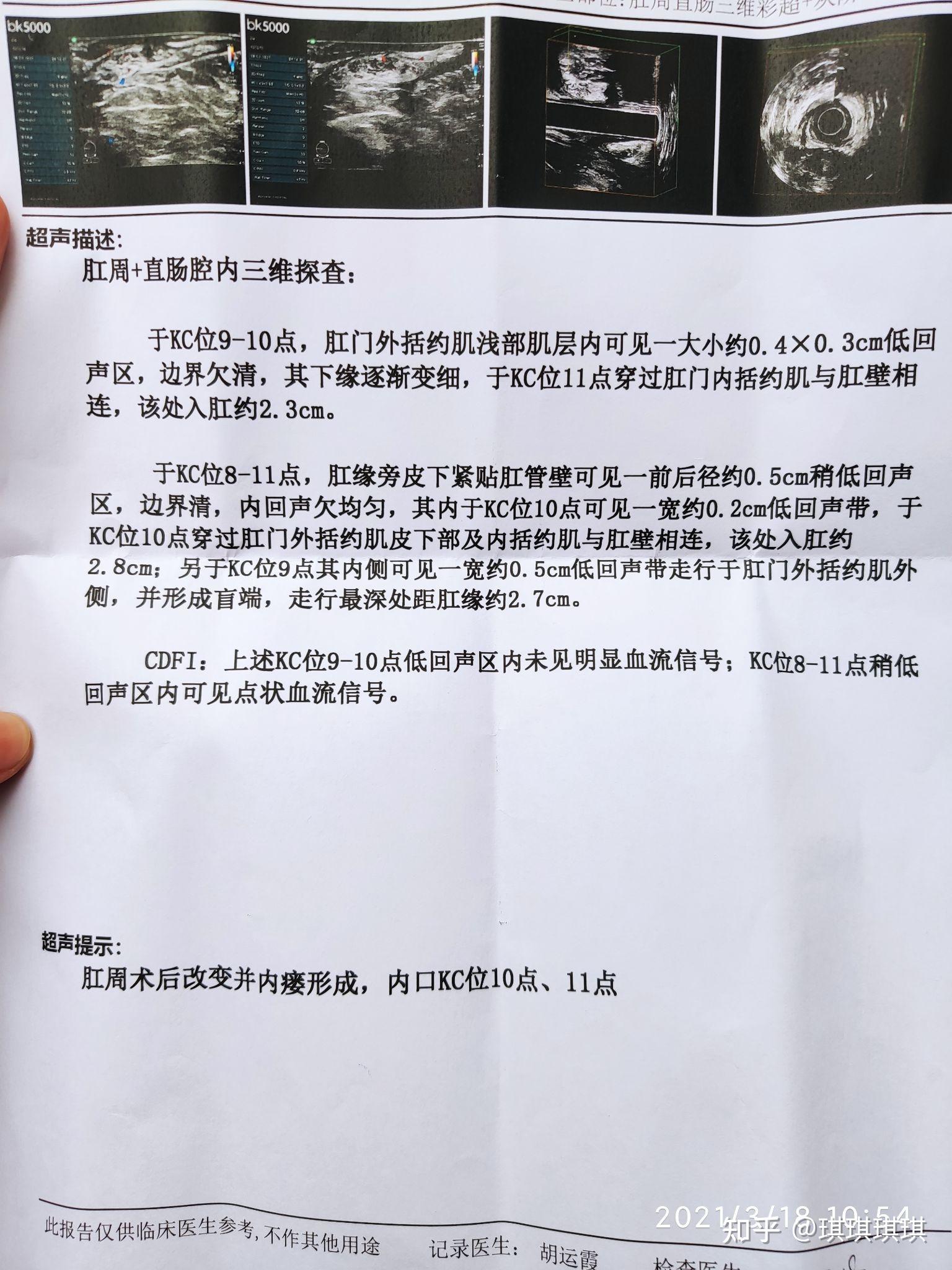 20210322,今天去找何潜主任复查了,他看了我检查单子,给我做了指检,说
