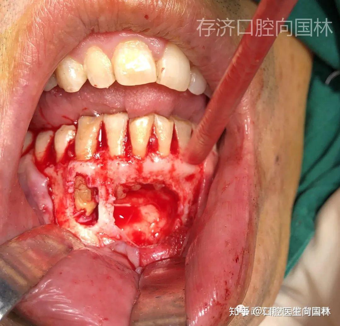 典型案例超聲骨刀下頜骨囊腫摘除根尖切除根管倒充填術