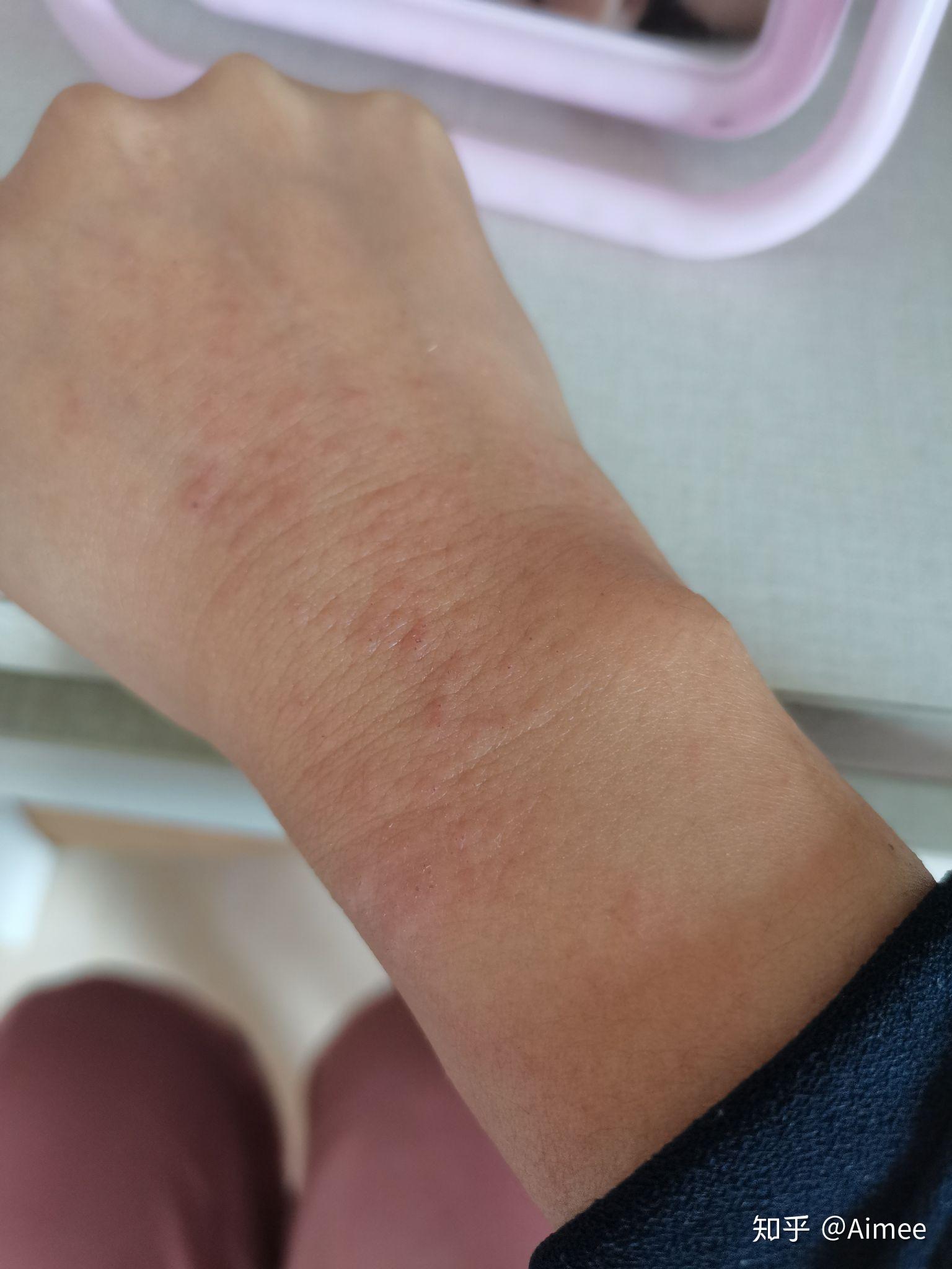 用兰蔻大粉水倩碧黄油过敏的有没有
