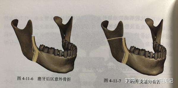 正颌手术有哪些常见的风险和并发症