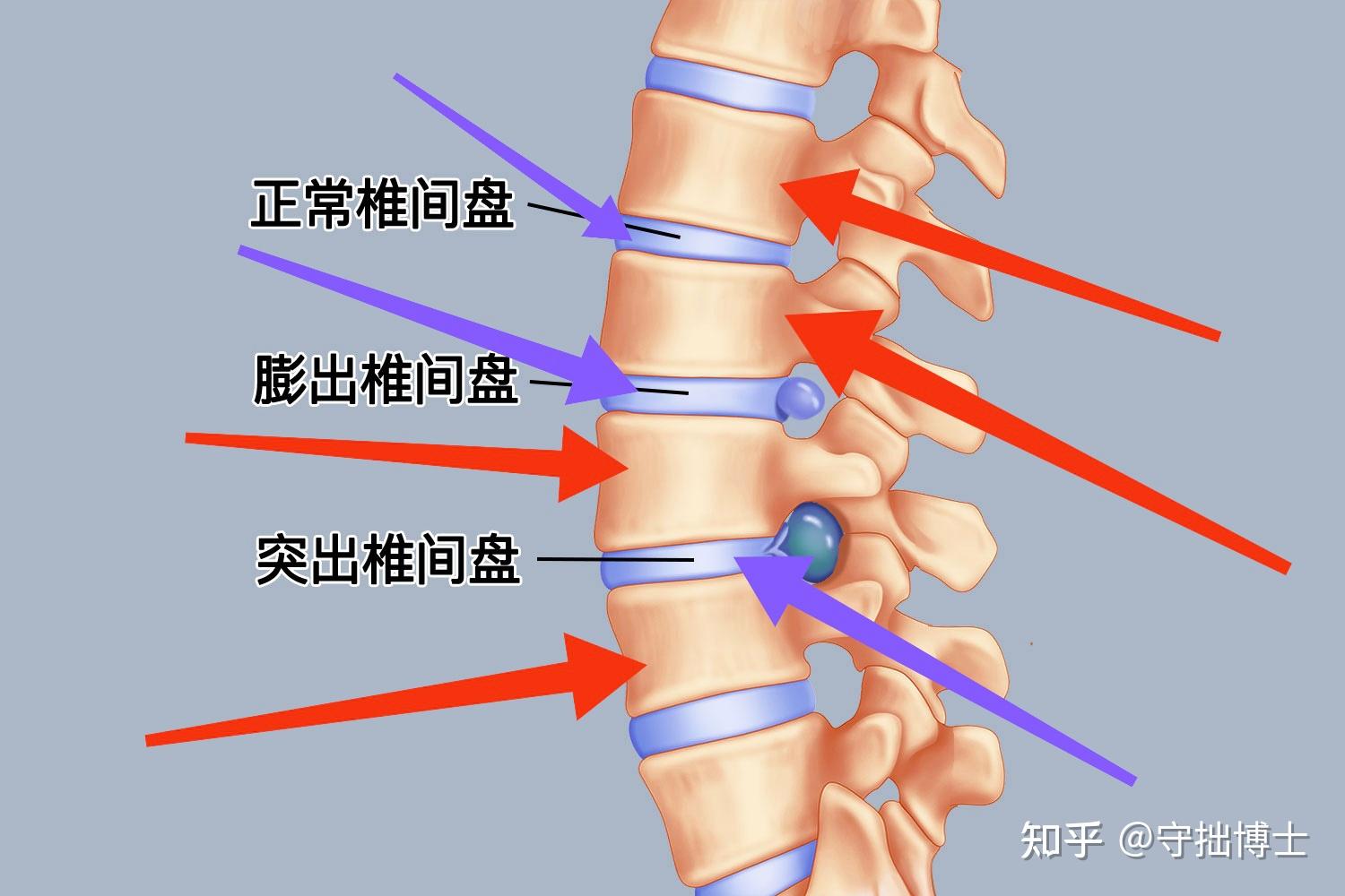 腰疼,去医院检查说是腰椎间盘有膨出,医生说多运动,可是也听别人说过