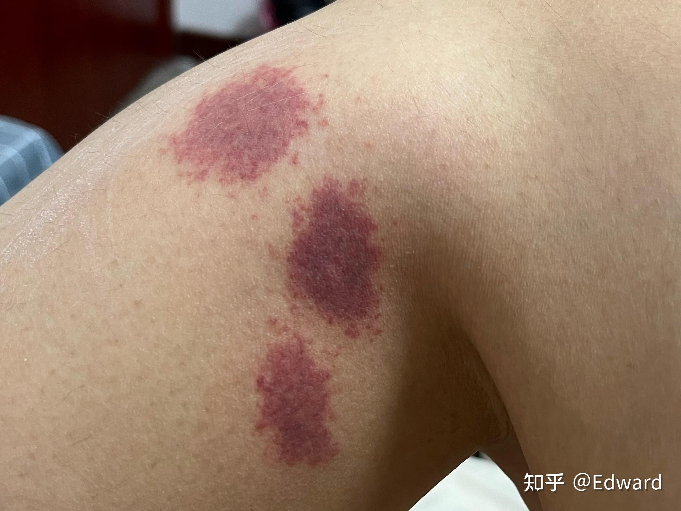 为什么我被蚊子咬了之后皮肤会变成类似淤青的紫红色,消退的很慢,肿的