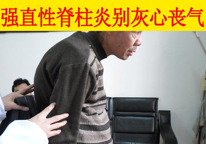 真情寄语500多万强直性脊柱炎患者