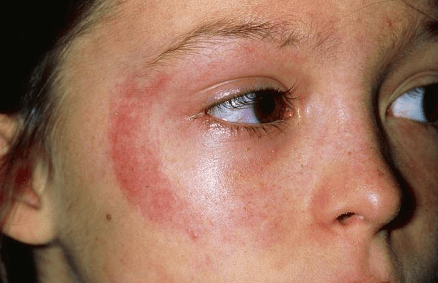 脸过敏还有红血丝反反复复就是好不了咋办