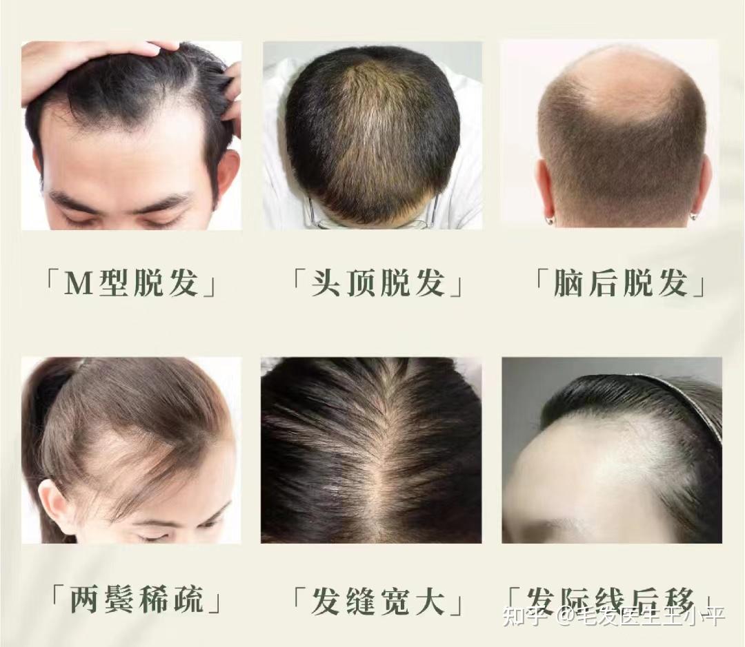 为什么现在年轻人秃头掉发现象这么普遍？有什么解决办法吗？ - 知乎