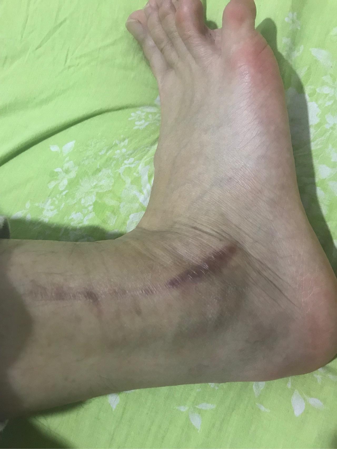 脚踝骨折近一年的恢复情况