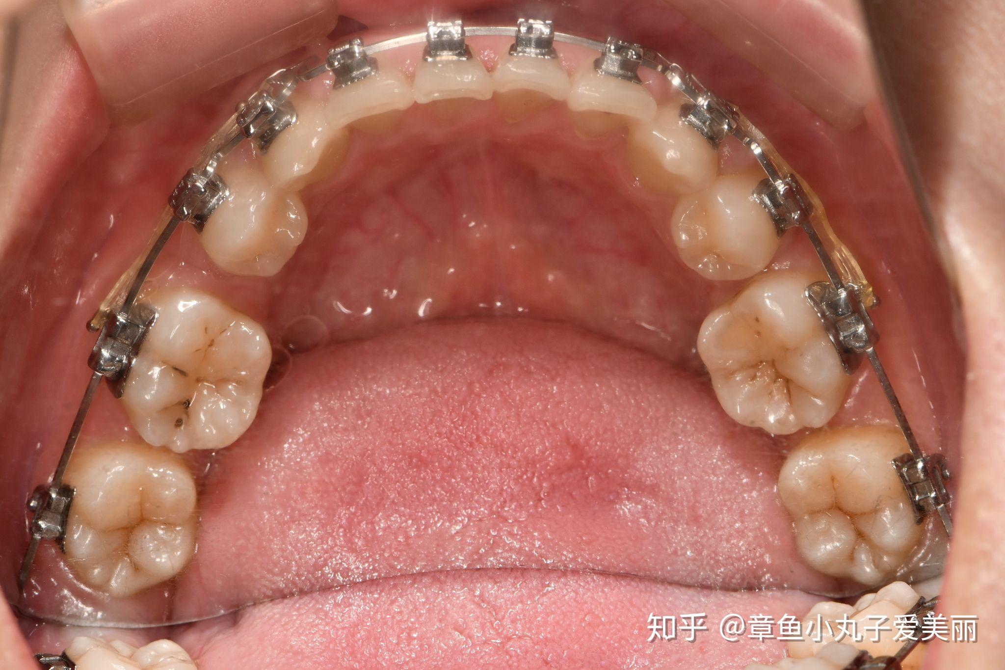 福州牙齒矯正效果明顯開始糾結戴哪種保持器