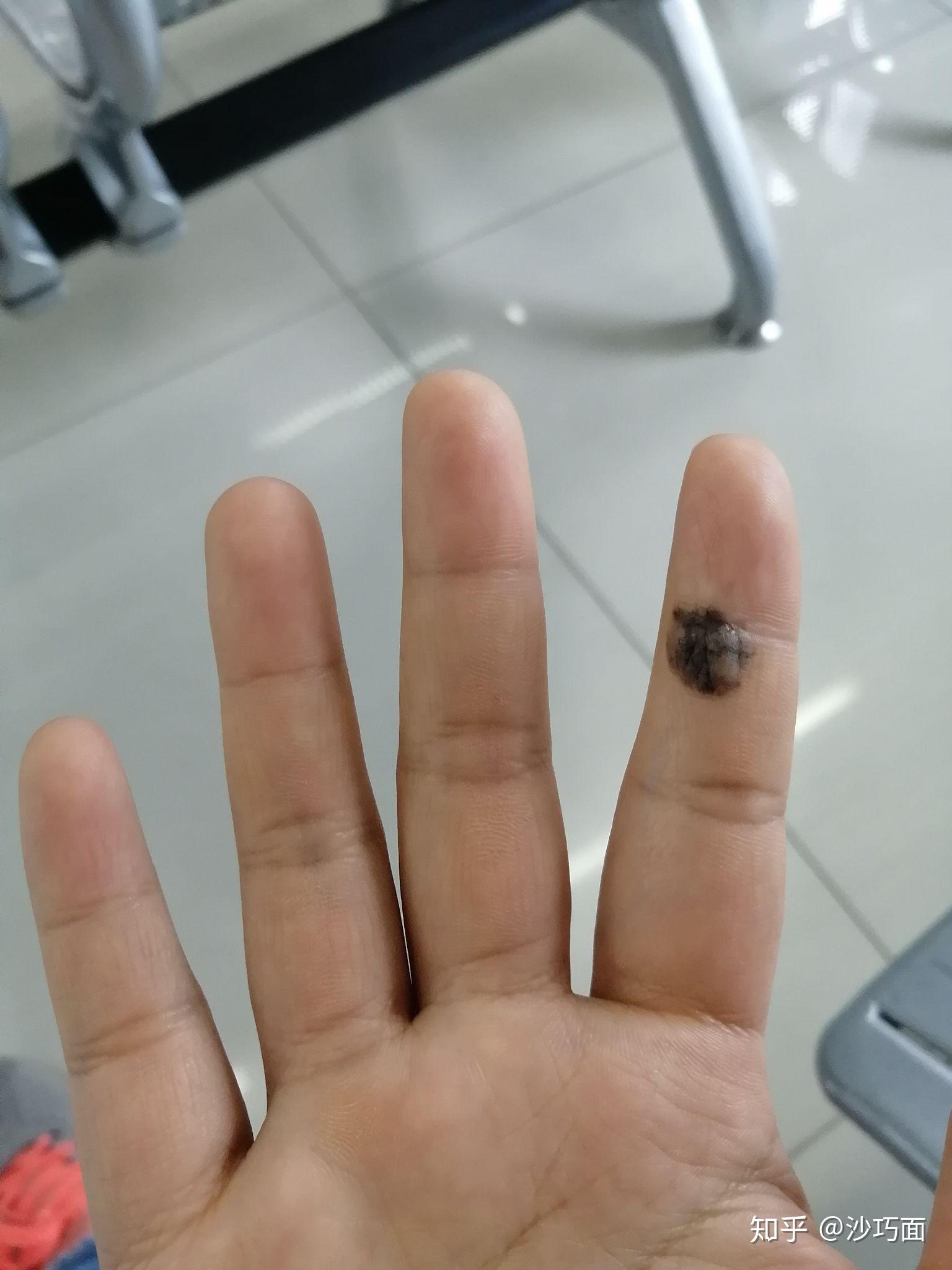 从小长在手上的痣,之前据说是平的,现在隆起一半褐色一半白色(已经