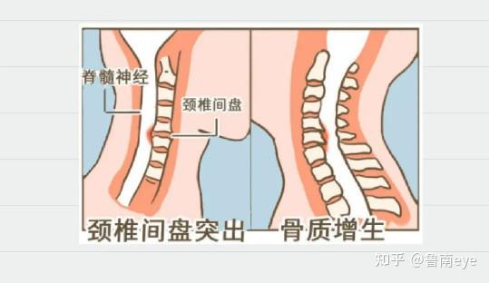 注意反复落枕要警惕