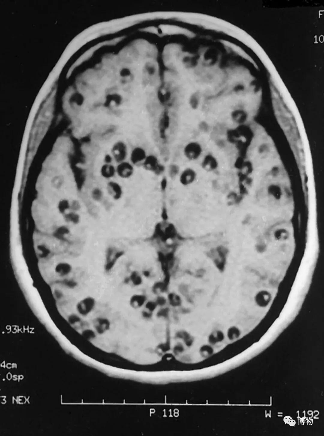 通过脑部扫描发现,他的大脑有肿胀和损伤,这是脑囊虫病(neuro