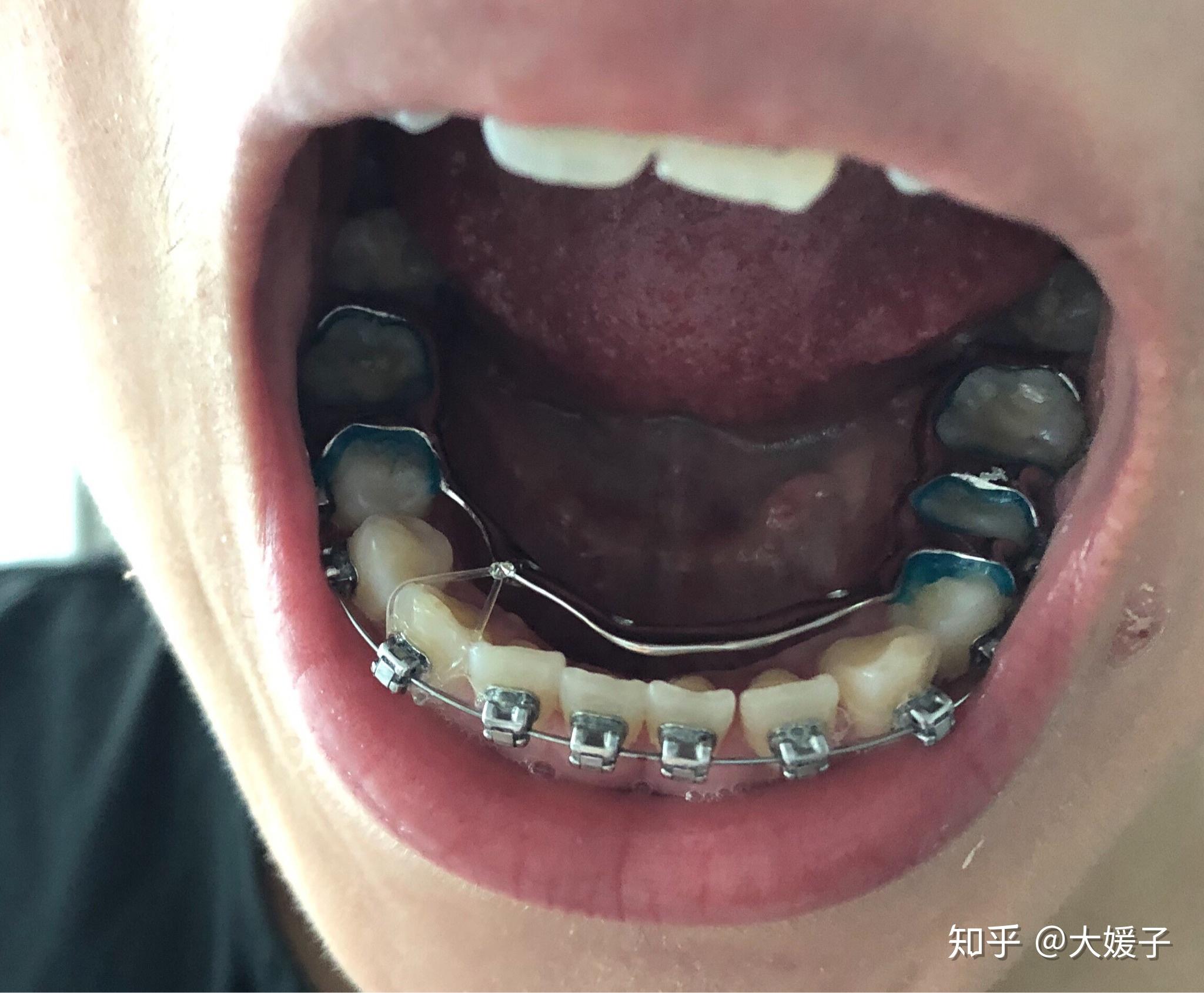 记录23岁才决定去正畸的稀疏小牙齿的日常 - 知乎