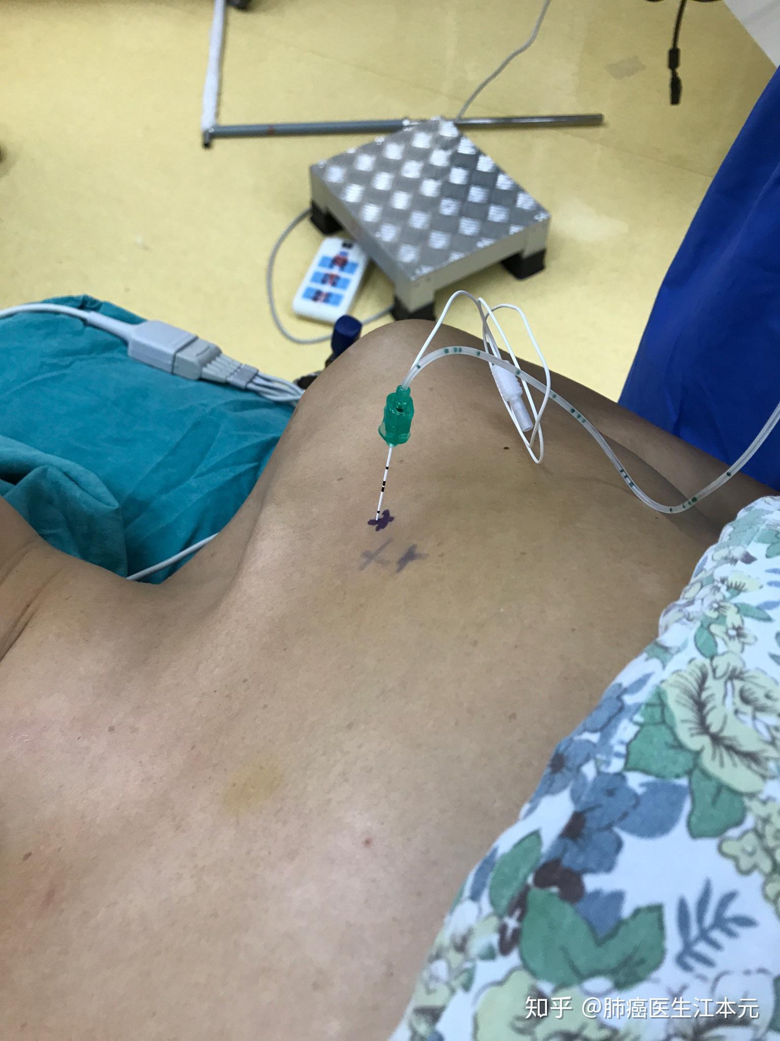 37岁男性,体检发现左上肺磨玻璃结节,患者担心ct穿刺定位有辐射,我们