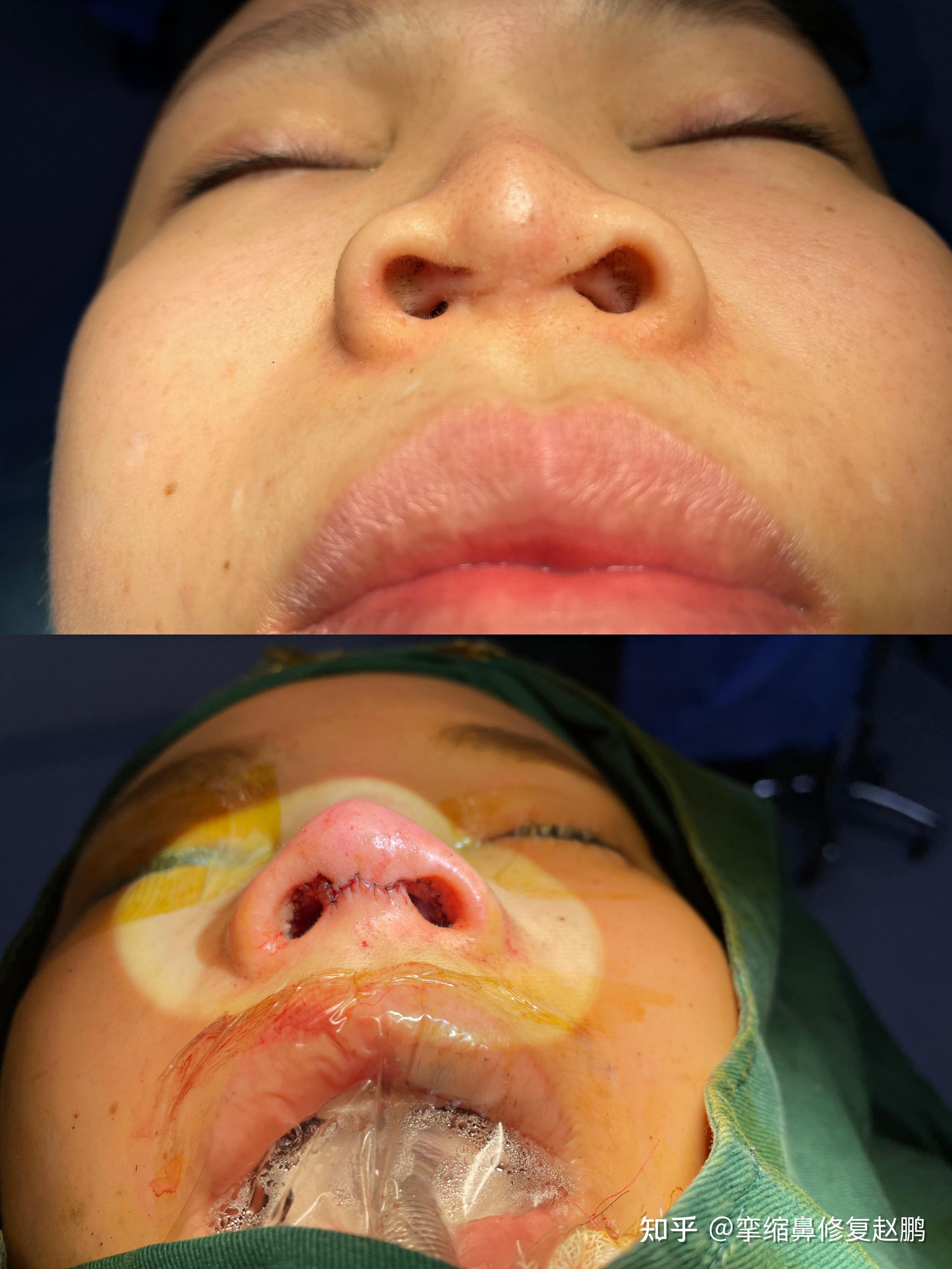 鼻小柱挛缩鼻孔内疤痕增生是什么原因造成的 