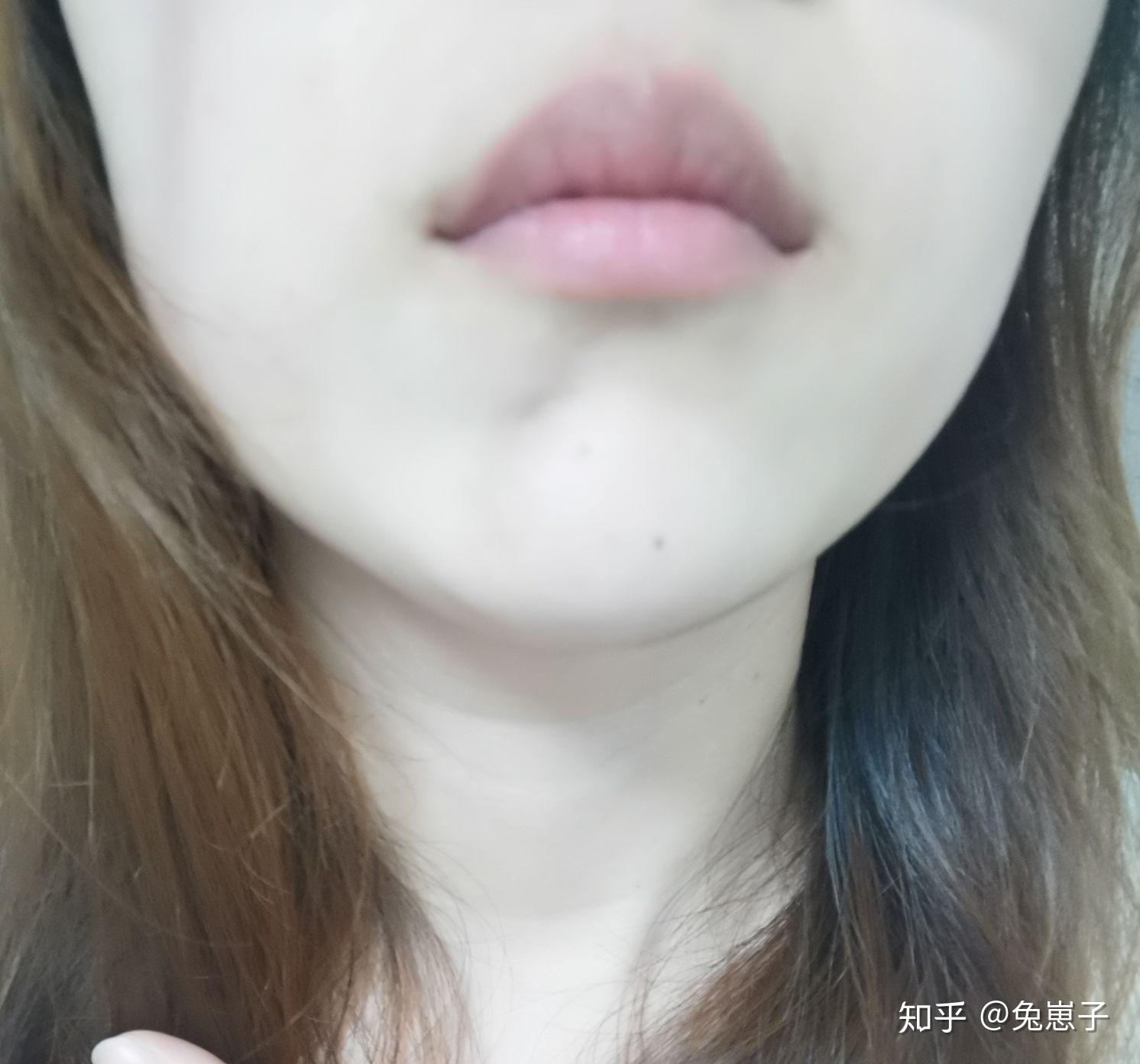 24岁女得了皮下脂肪萎缩,下巴凹陷一块.怎么办?