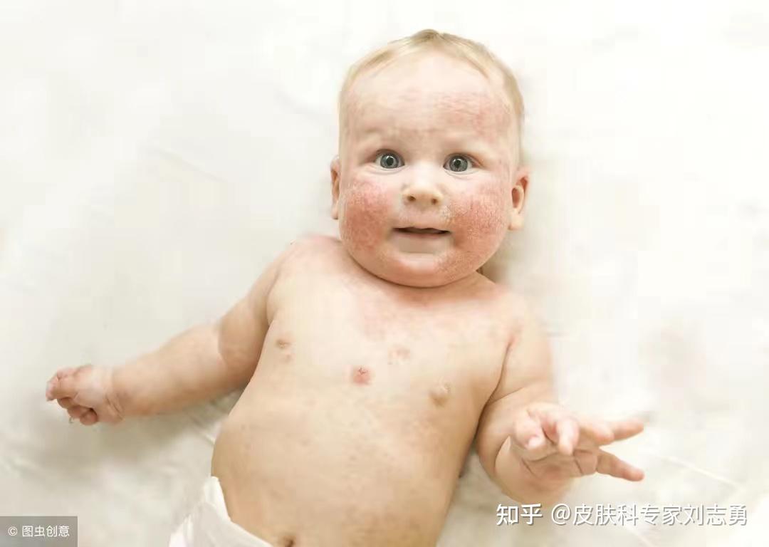 宝宝湿疹和热疹怎么分辨图片区别是什么（夏天来了，宝宝热疹和湿疹要区分） | 说明书网