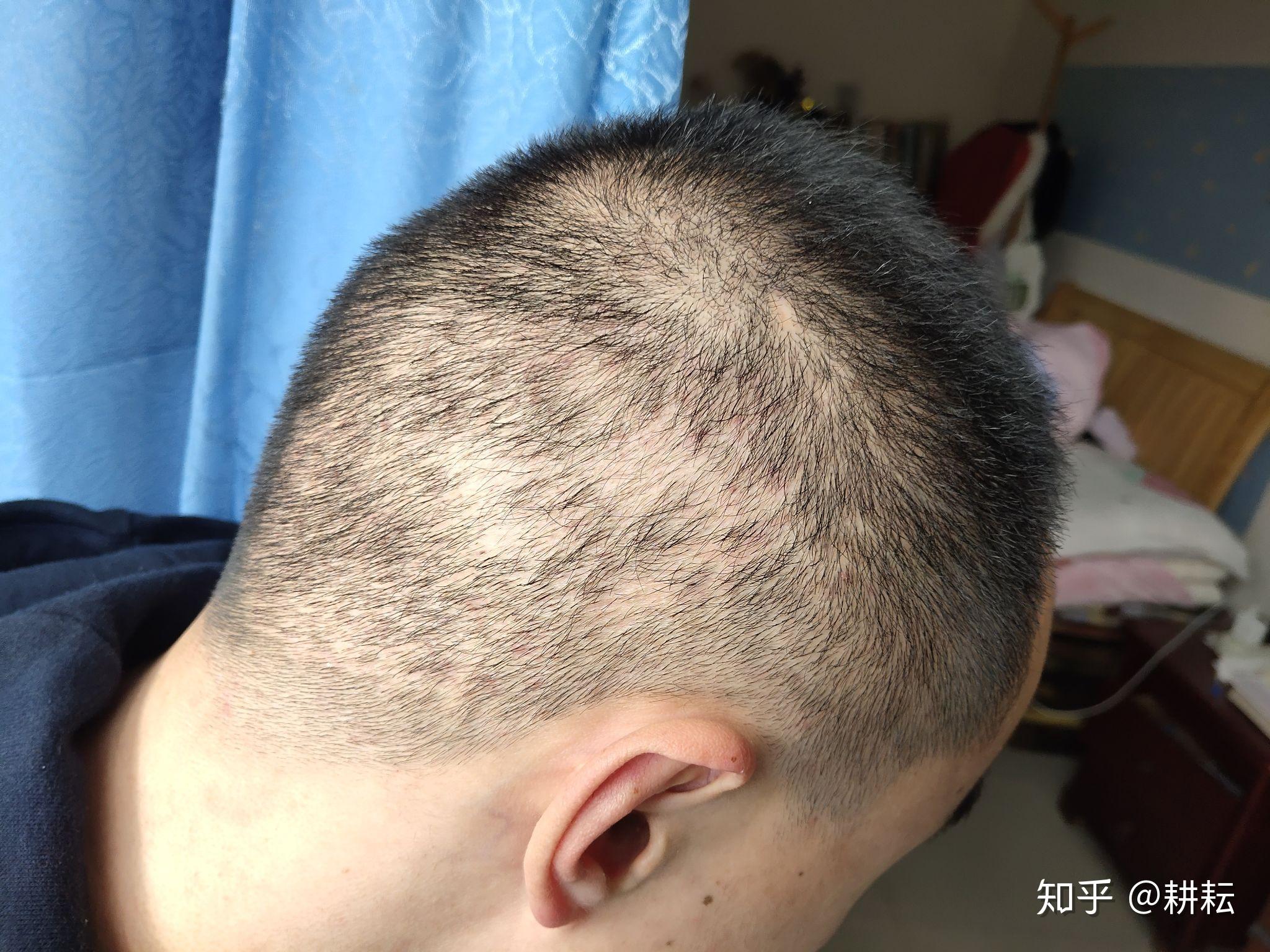 FUE微創植髮讓髮際線更濃密 - 萌髮植髮診所