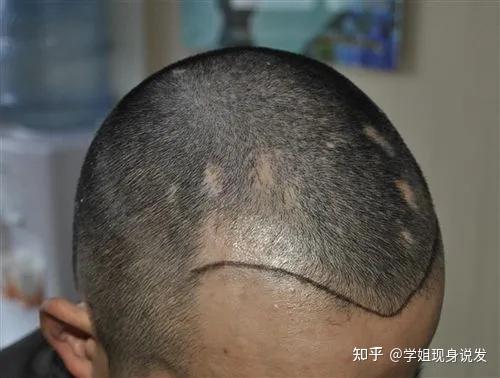 头上有疤痕可以植发吗?价格高不高,存活率高吗? - 知乎