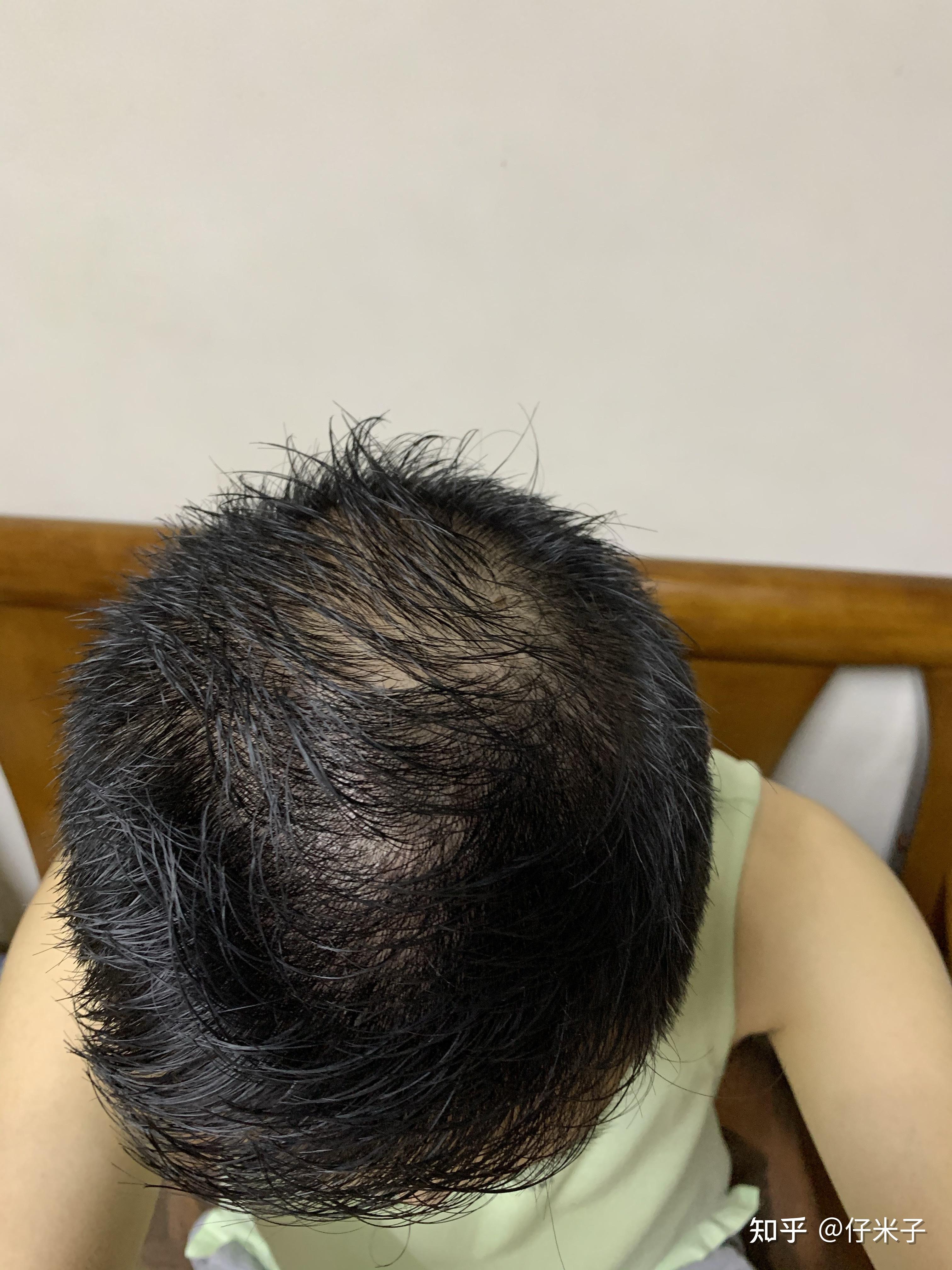 90年微针加米诺治疗脱发