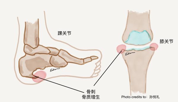 骨头上长了 刺 怎么破 知乎