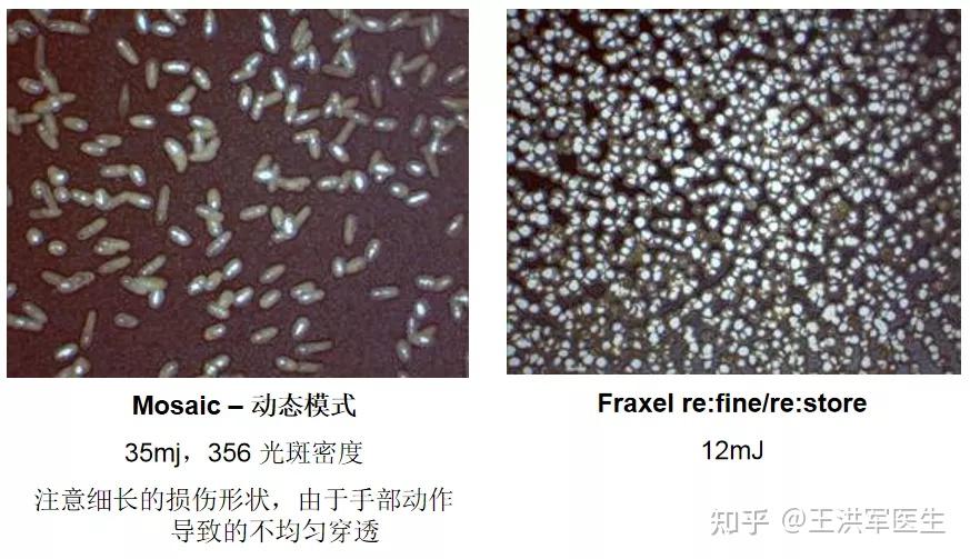飞梭雷射Fraxel, 美白、缩毛孔效果好! - 知乎