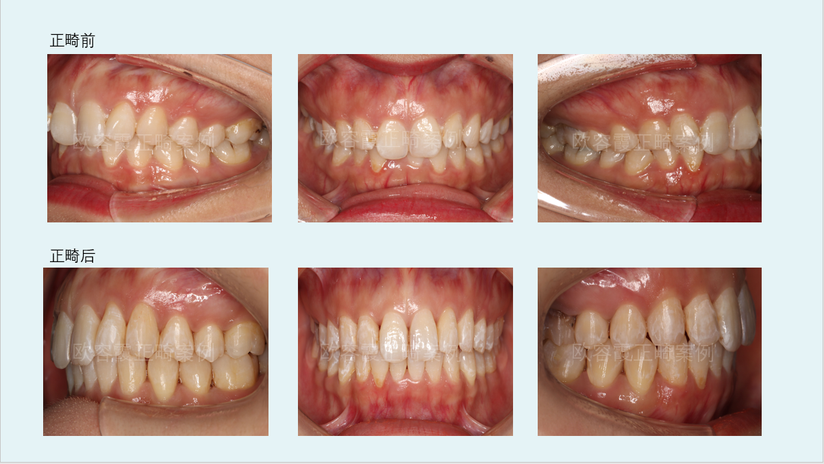 深圳牙齒矯正∣深覆合美學修復正畸聯合治療