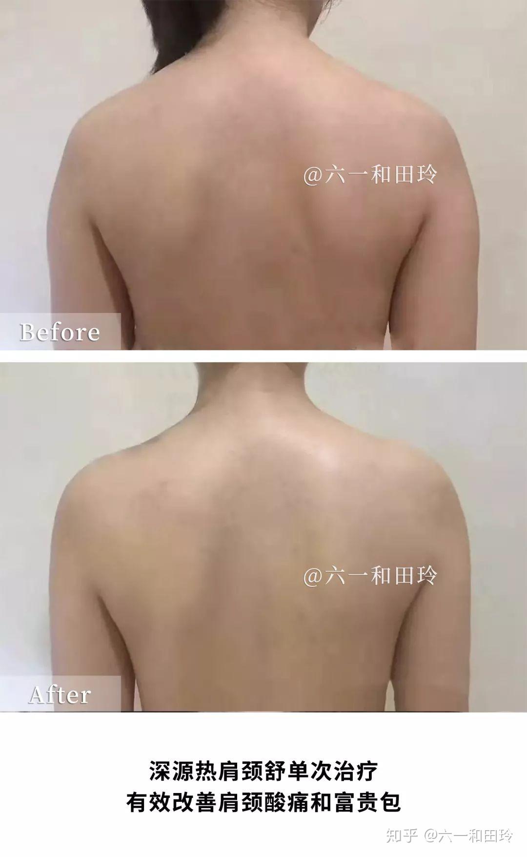 做什么运动可以改善腰肌劳损 v2-c1abb7efa1dff26afbe58964f9f8a1e0_r.jpg