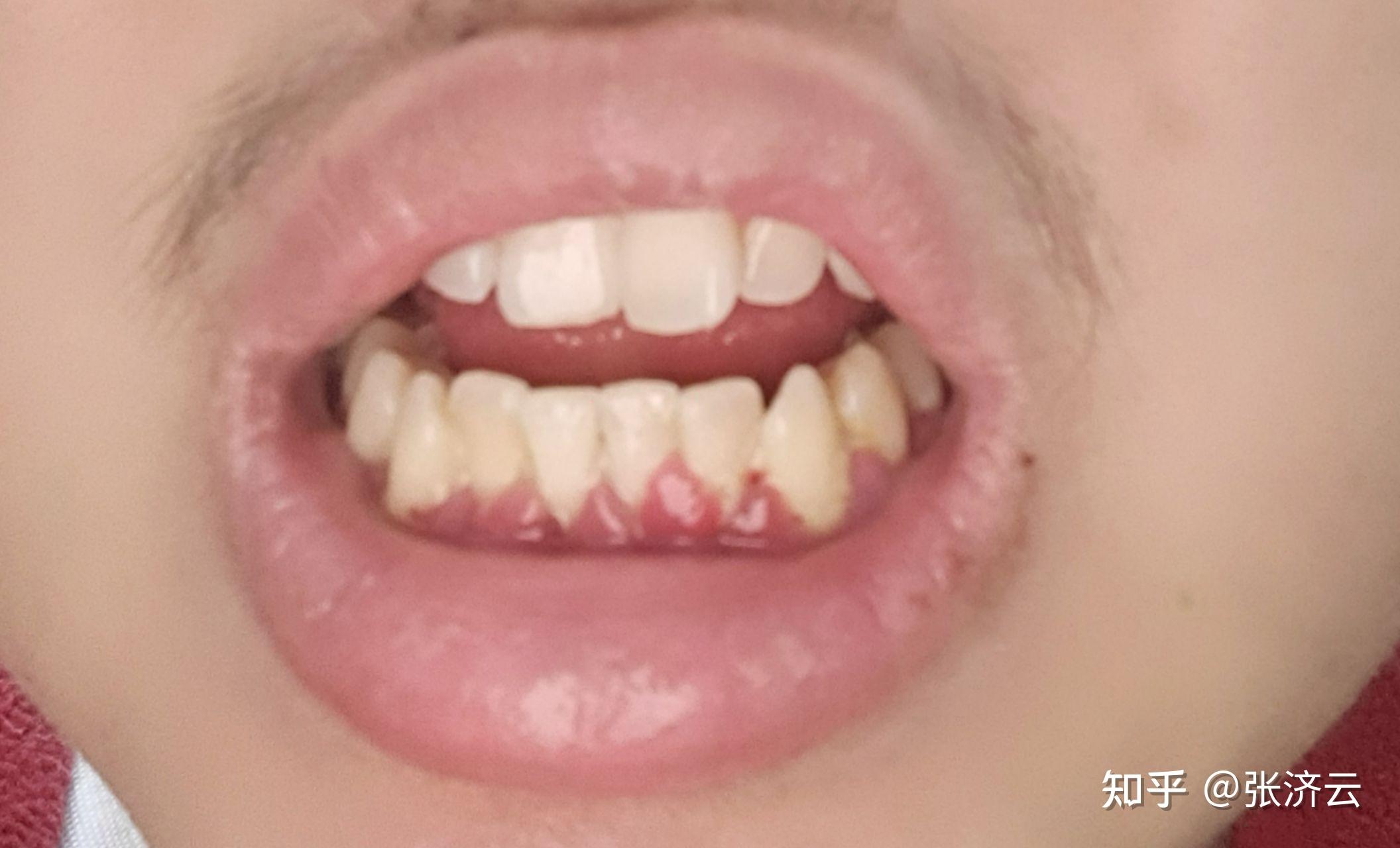 有人做过龈下刮治吗