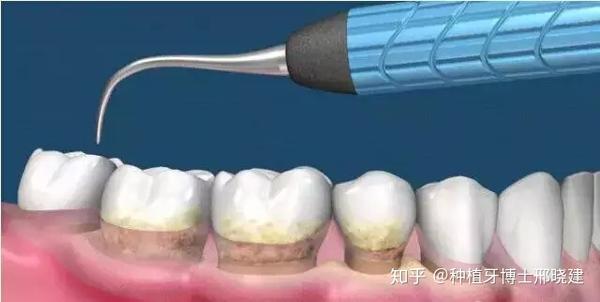 去医院洗牙划算 还是自己买个洗牙机器划算 知乎