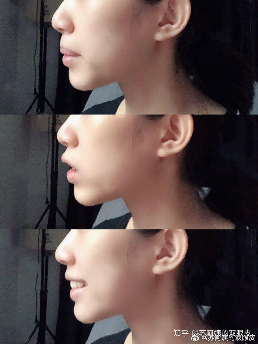 下巴截骨前移是什么样的体验