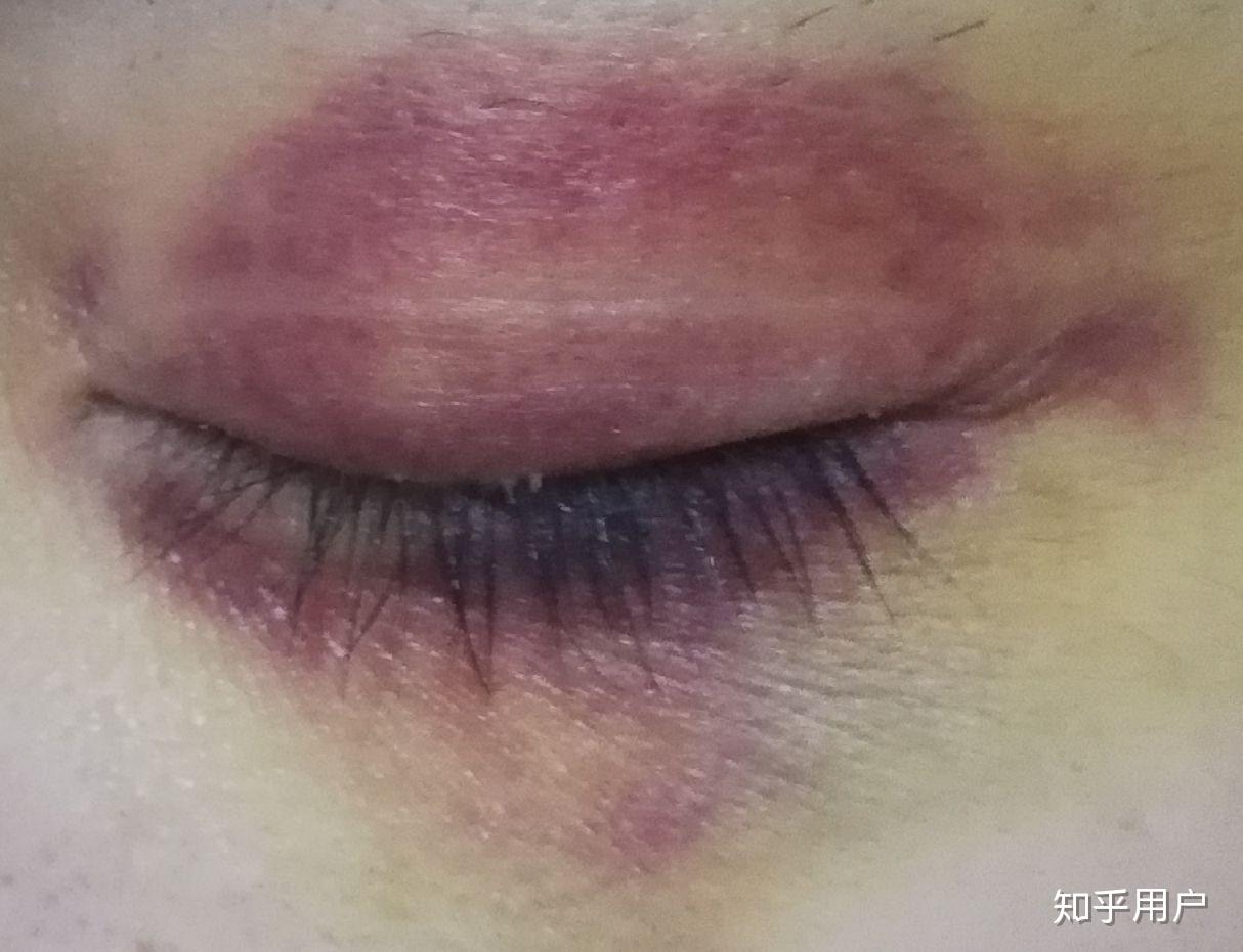 想知道眼部淤青怎么可以快速消除