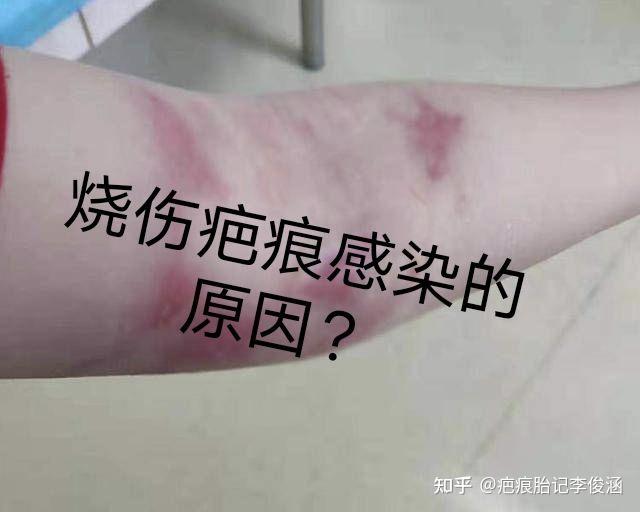 烧伤疤痕感染的原因? - 知乎
