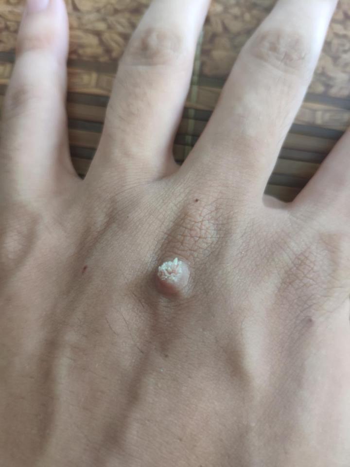 身上长了"瘊子"怎么治?中医良方轻松治!