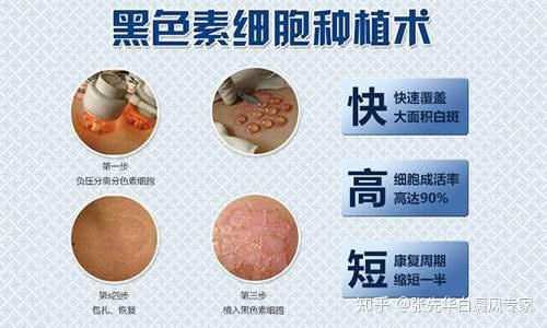 中医治疗白癜风：古老智慧与现代需求的完美结合