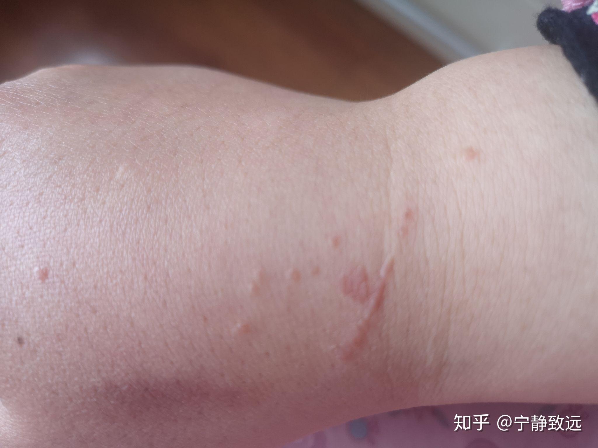 我的扁平疣治好了