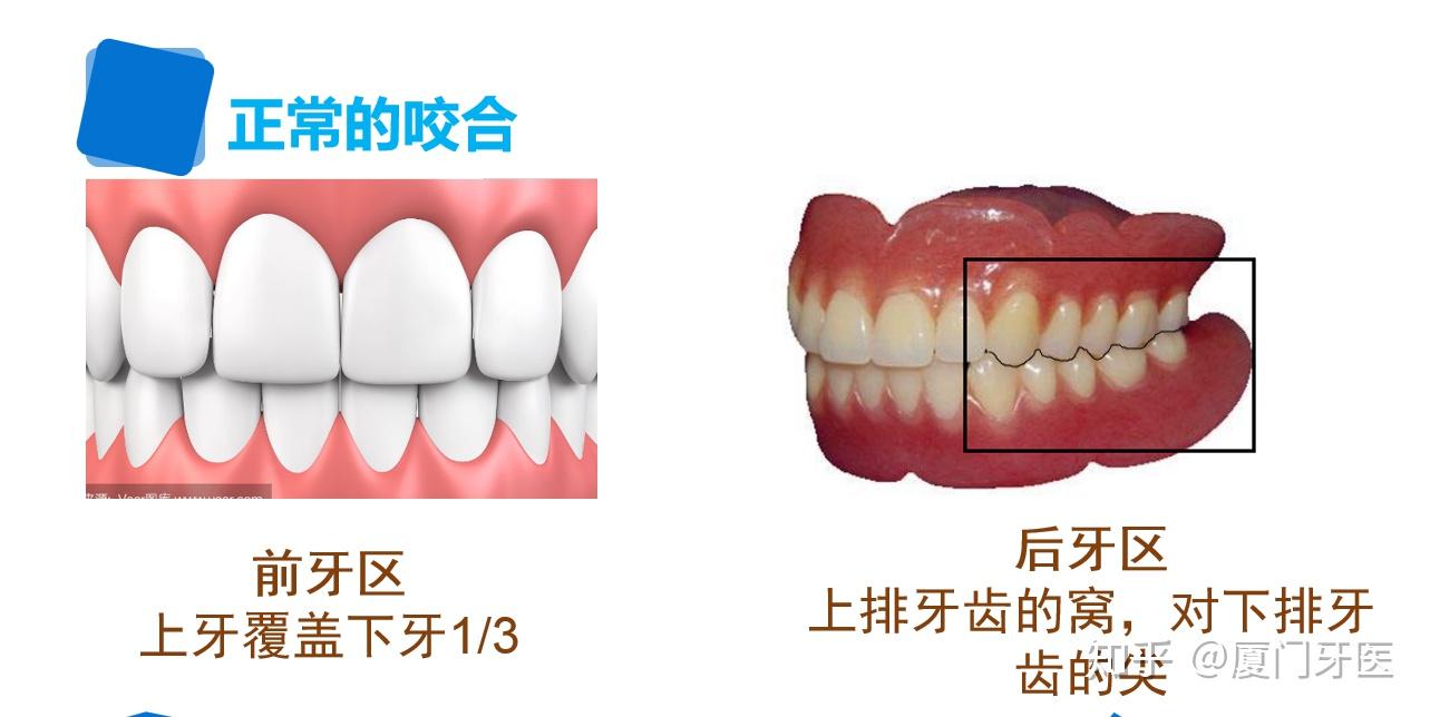 牙齿后牙全部咬合上前面的上下门牙应该之间应该留有缝隙吗