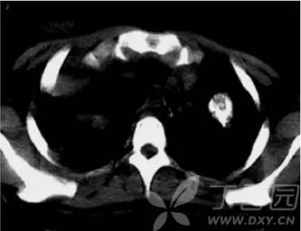 转移性肺癌CT表现特点大盘点