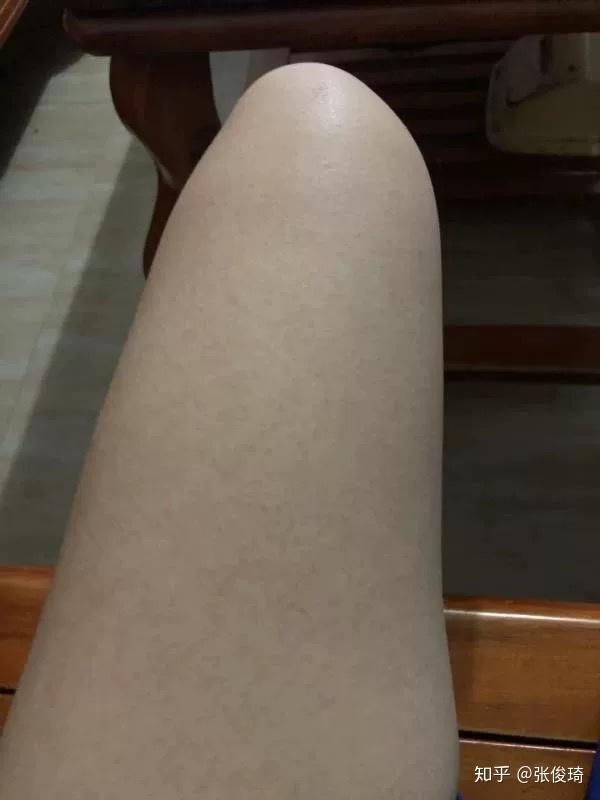 鸡皮肤的人容易脸红吗(脸上遗传性鸡皮肤脸红很严重)